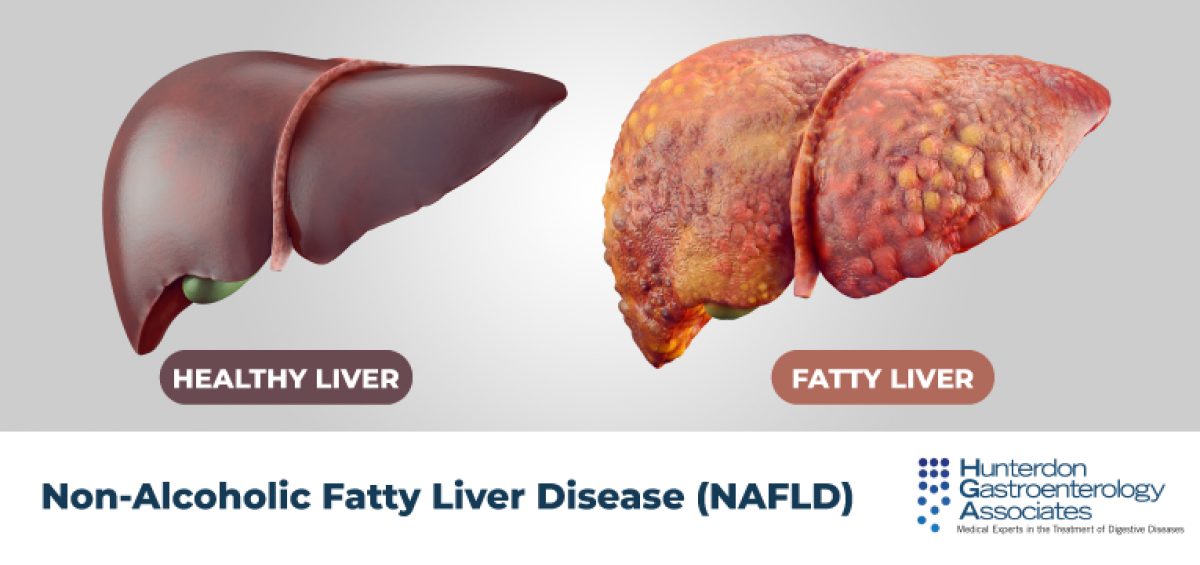 Non-Alcoholic Fatty Liver Disease: A Complete Guide to Causes, Diet, and Reversal